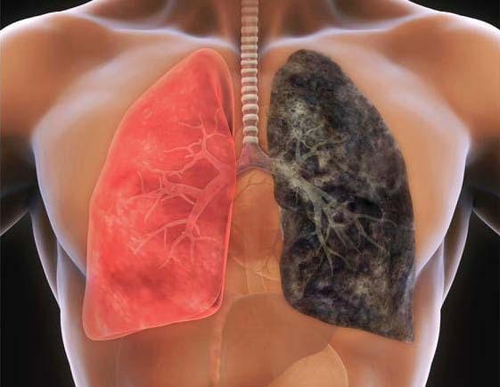 Lung Cancer and Non-Smokers - Lungcancer
